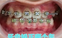 矫正牙齿去哪里做好？选机构要注意哪些关键点？