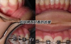 牙外突矫正牙齿