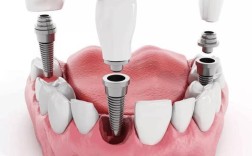 种植体露出来是何原因？该如何处理？