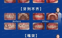 正畸治疗中牙列拥挤的分类标准及意义是什么？