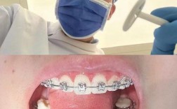 矫正后牙齿为何变黄？原因及应对方法