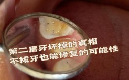 拔了第二磨牙后不种牙，邻牙会松动吗？咀嚼功能受影响怎么办？有哪些替代修复方案需要注意？