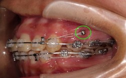 正畸微种植钉植入视频适合哪些口腔医生学习？能否通过视频掌握植入角度、深度等关键操作要点？