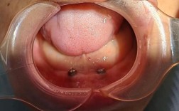 科瓦齿科种牙效果如何？安全靠谱吗？