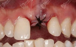 种牙拆线后为何还肿？是正常现象吗？