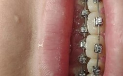 牙齿矫正视频大全，能找到哪些实用矫正方法？