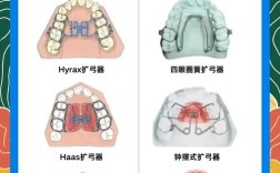 正畸扩弓器分类