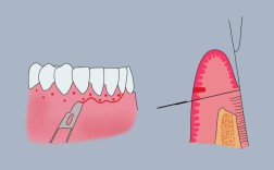 牙周手术缝合方法的选择与操作要点是什么？