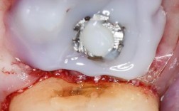 拔牙后2年种植牙