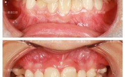 华美整形矫正牙齿