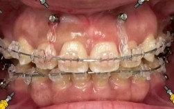 矫正牙齿不打支抗钉