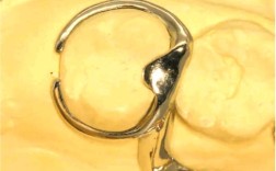 牙齿矫正上卡环