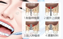 种牙上颌窦提升为何敲几下？敲击次数多少才合适？