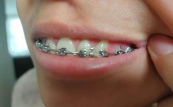 矫正牙齿牙龈增生图片