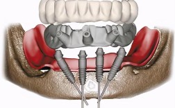 3D技术种牙有哪些优势？效果和安全性如何？