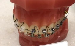 透明托槽正畸效果如何？隐形美观舒适度靠谱吗？