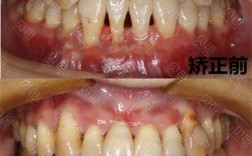 牙周炎能做牙齿矫正吗？需满足哪些条件？