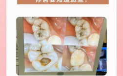 口腔有坏牙为何会影响种牙？