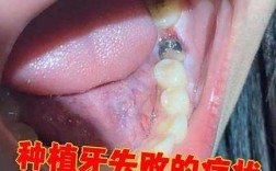 植牙后为何看不见牙根？是正常情况还是存在问题？需要处理吗？