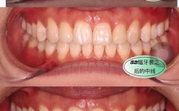 牙齿矫正失败的照片，究竟哪里出了错？