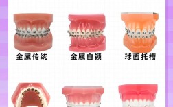 矫正牙齿的材料分哪几种？金属、陶瓷、隐形等哪种更适合自己？