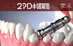 2025种植牙还会掉吗？最新案例警示！