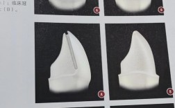 不良修复体制备方法存在哪些常见问题？如何通过改进方法提升质量？