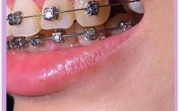 30岁矫正牙齿还来得及吗？成年人矫正有年龄限制吗？