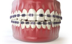 牙齿矫正有年龄限制吗？最佳矫正年龄是几岁？