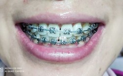 自己挂正畸橡皮链可行吗？关键操作技巧要掌握！