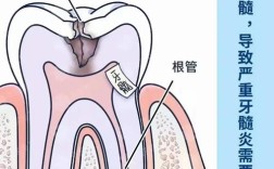 根管钉使用方法