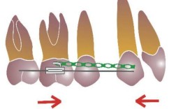 正畸关闭拔牙间隙有哪些常用方法？