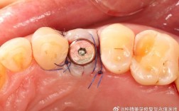 种牙愈合基台