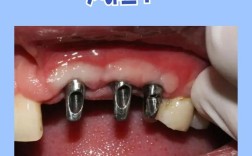 什么地方能种牙