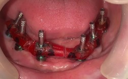 种植牙能取下来吗？