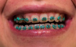 牙齿矫正收牙缝图片能真实反映矫正效果吗？