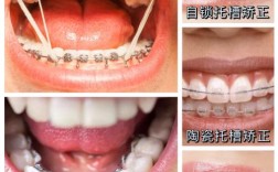 牙齿正畸选什么牙套？不同类型优缺点及适用人群有哪些？