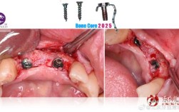 下颌前牙骨增量正畸