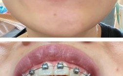 25岁矫正牙齿还来得及吗？成年人矫正牙齿有年龄限制吗？