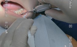 正畸在什么阶段打钉子