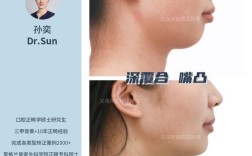 牙齿矫正会让嘴变突吗？30秒看矫正是否真的导致嘴前突