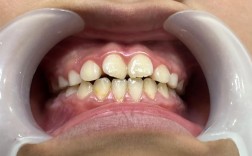 矫正牙齿2-4个月能完成矫正吗？