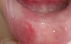 正畸为什么会口腔溃疡