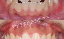牙齿不齐拔除后正畸