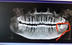 正畸智齿还没长出来