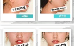 过小牙正畸要拔了吗