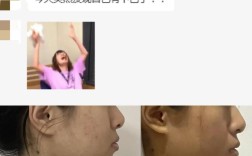 下颌后缩正畸手术效果如何？适合哪些情况？