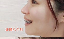 正畸是最漫长的整容