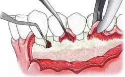 牙周病常见手术方法有哪些？哪种更适合患者？