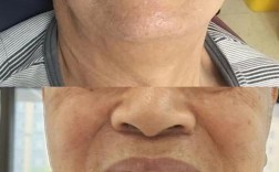 70岁老人能否种牙成功？年龄是否为绝对限制，身体状况和术后恢复需关注哪些关键问题？